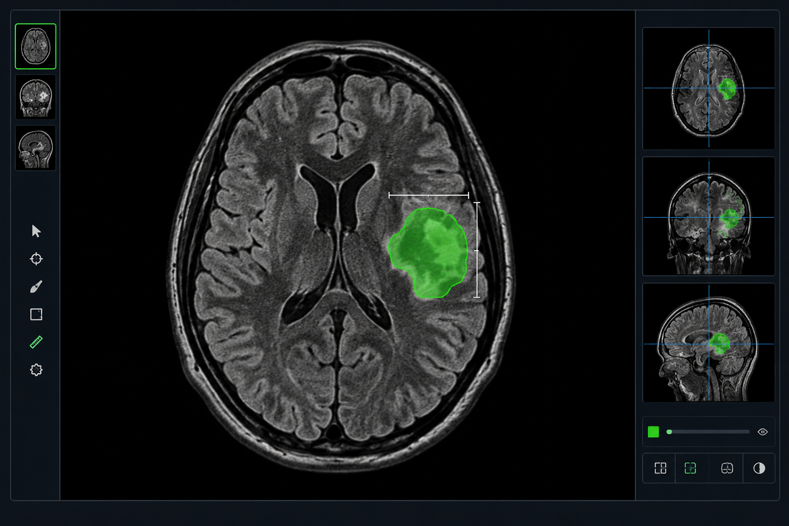 Brain MRI scan with an AI segmentation overlay highlighting a region of interest in green