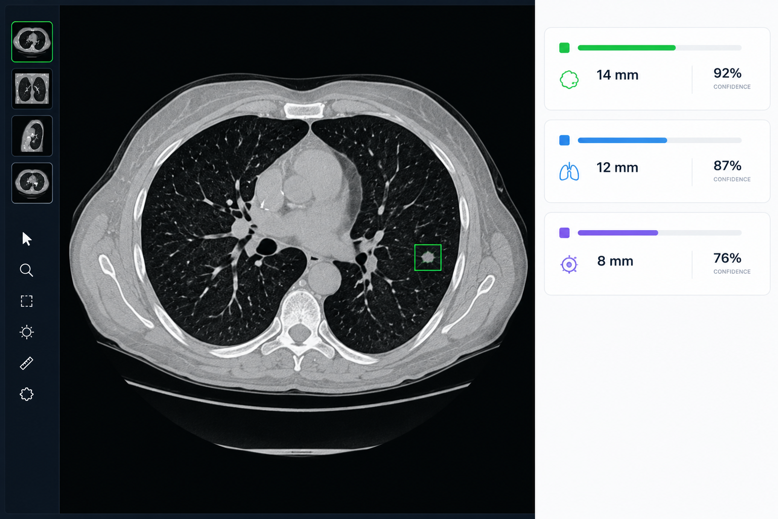 AI findings panel with measurements and confidence scores next to a CT scan