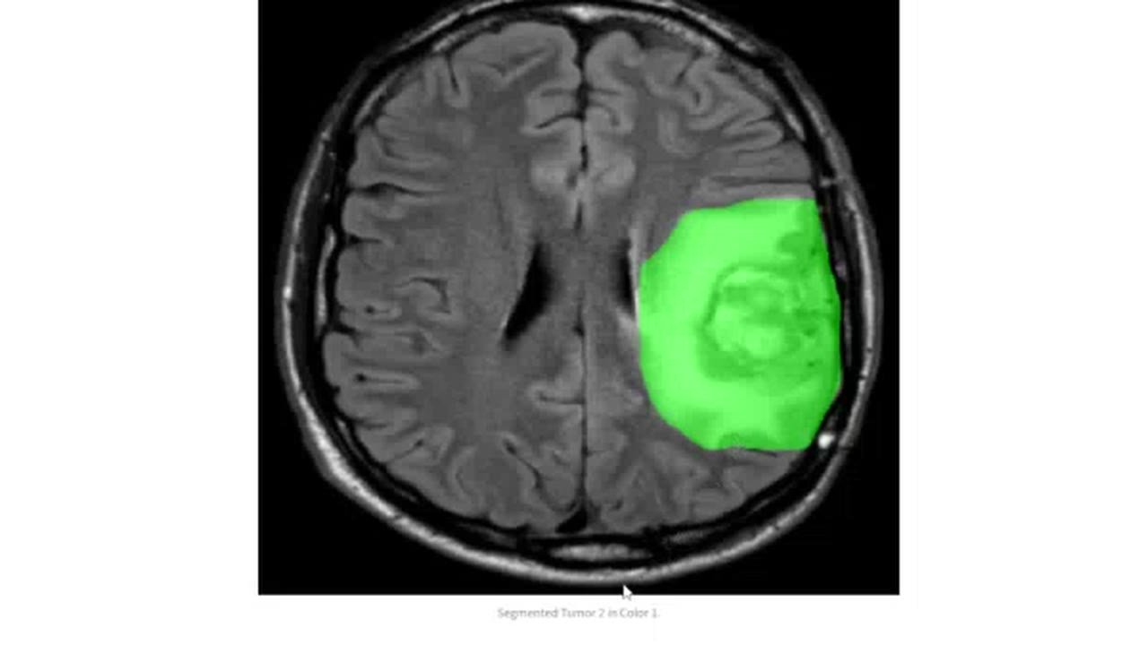 AI segmentation highlighting a brain tumor on an MRI scan